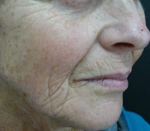 Laser Facial Resurfacing Before and After