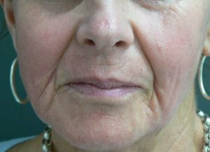 Laser Facial Resurfacing Before and After