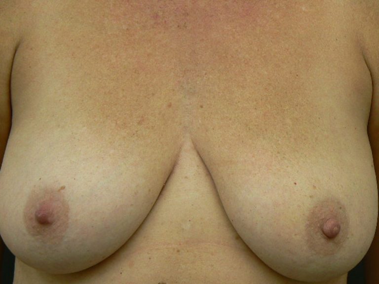 Breast reduction.  Encorė Cosmetic Clinic