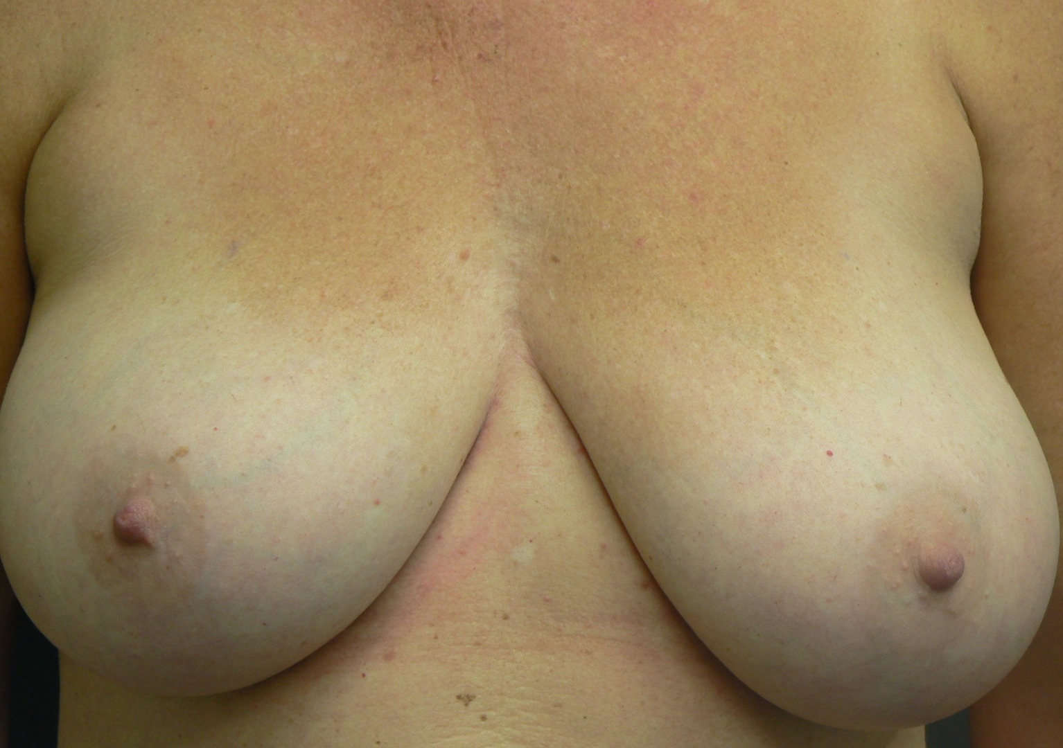 Breast reduction. Encorė Cosmetic Clinic
