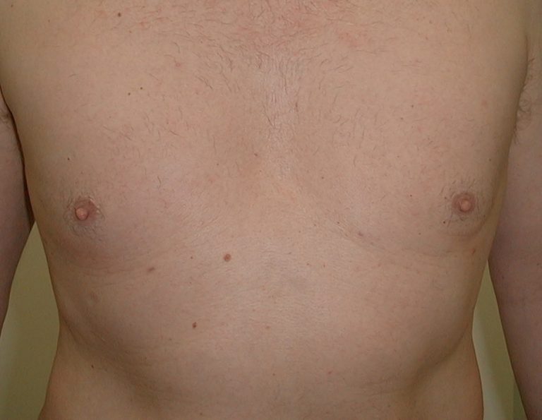 Male Breast Reduction. Encorė Cosmetic Clinic