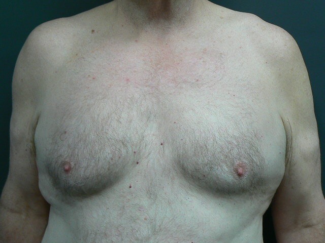 male breast reduction. Encorė Cosmetic Clinic